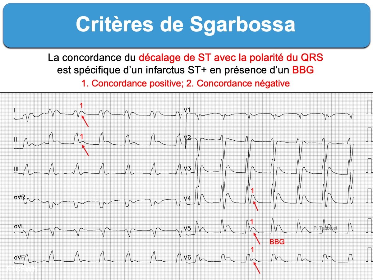 Critères de Sgarbossa — exemples tracés ECG concordance