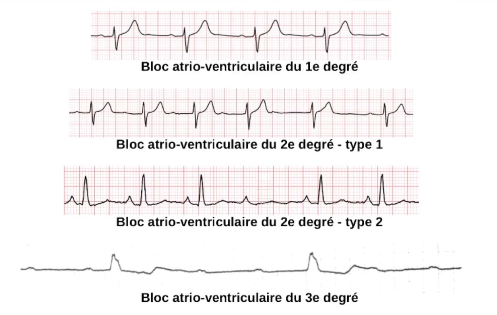 BAV tracings — exemples ECG BAV I, II type 1, II type 2, III