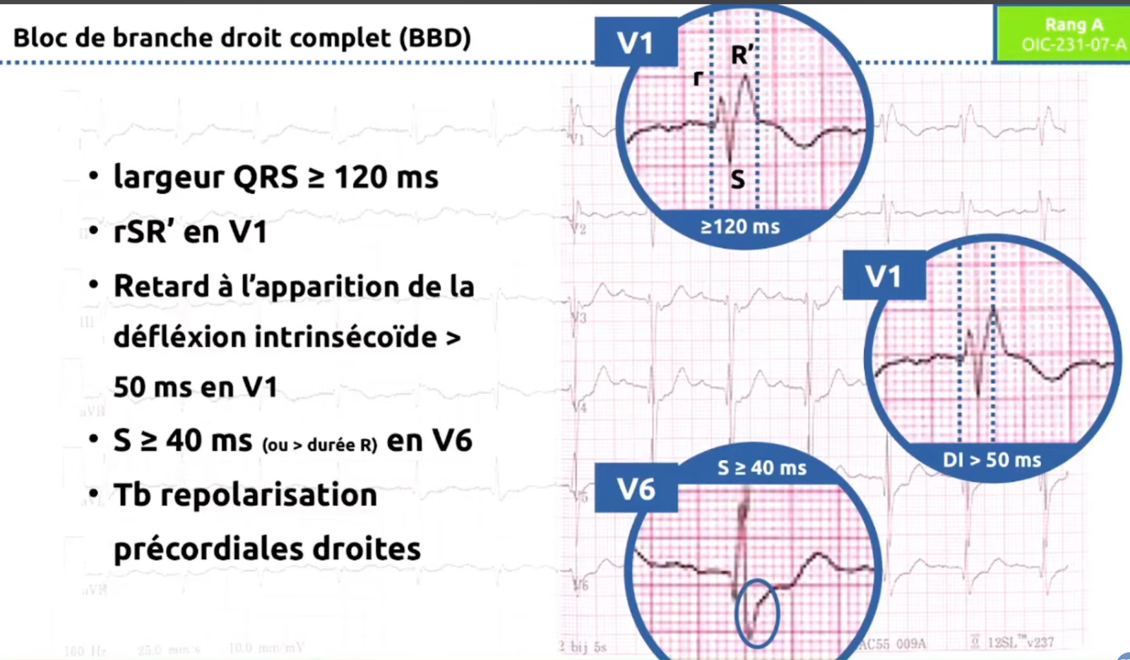 BBD critères ECG et tracés