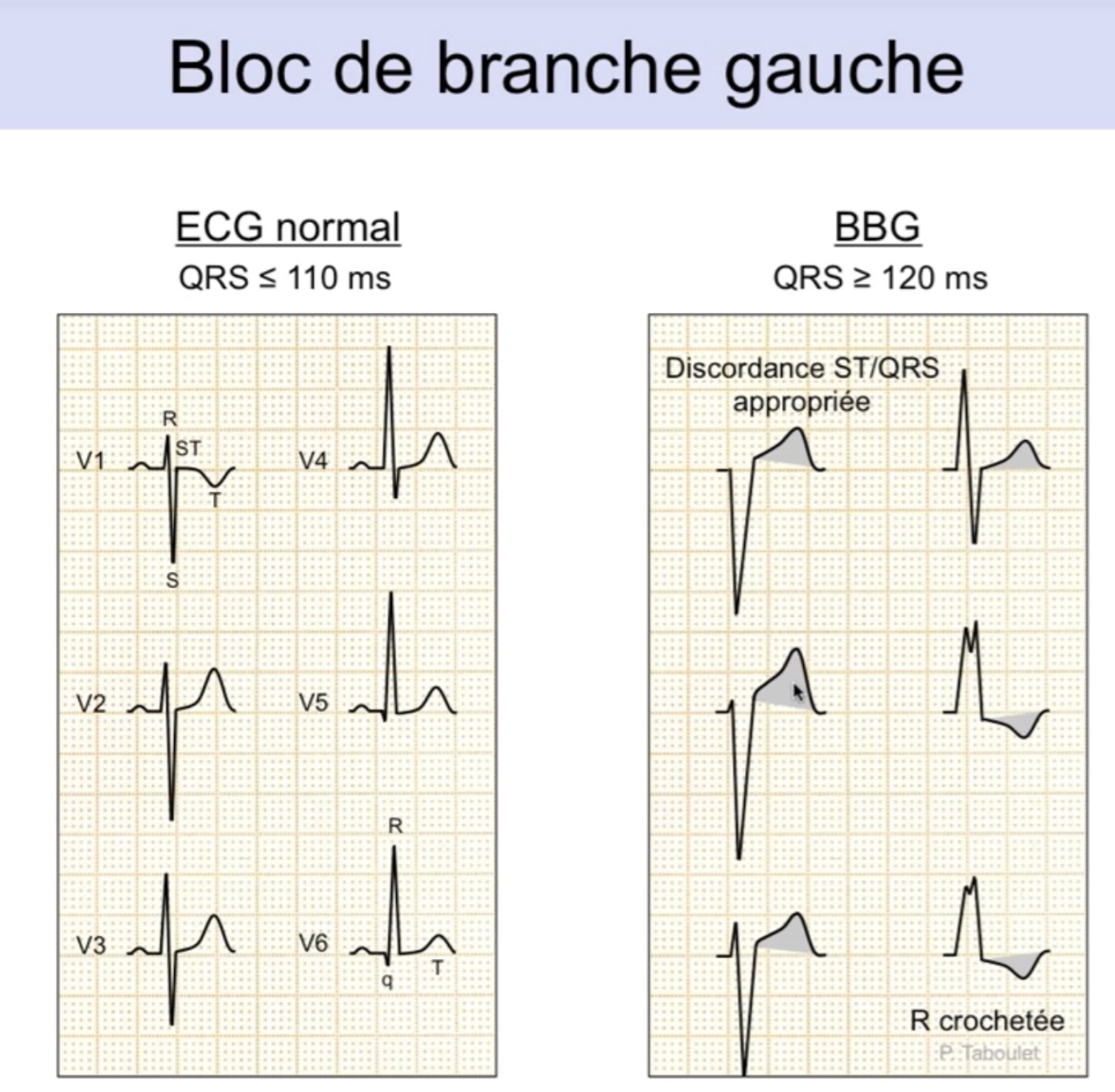 BBG vs ECG normal — QRS ≥ 120ms, discordance ST/QRS appropriée, R crochetée en V6