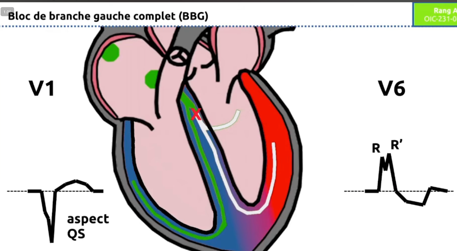 BBG schéma anatomique — aspect QS en V1, RR' en V6