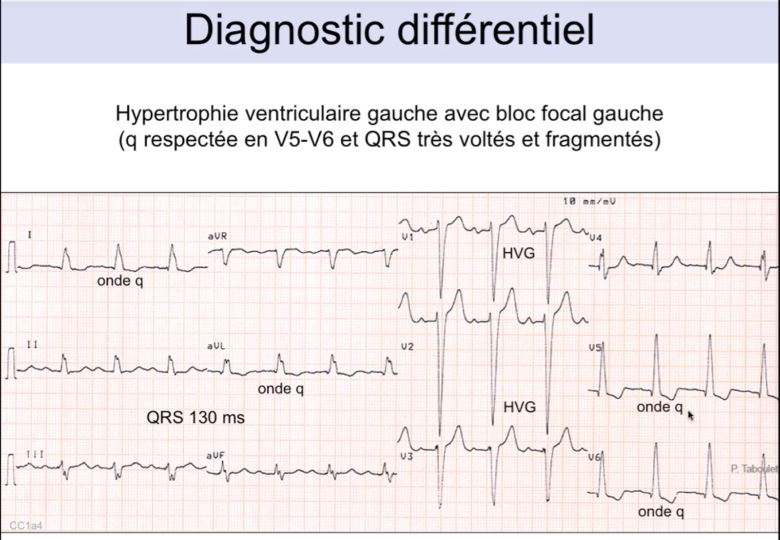 Diagnostic différentiel BBG vs HVG — onde q respectée en V5-V6 dans l'HVG, QRS 130ms, voltages élevés