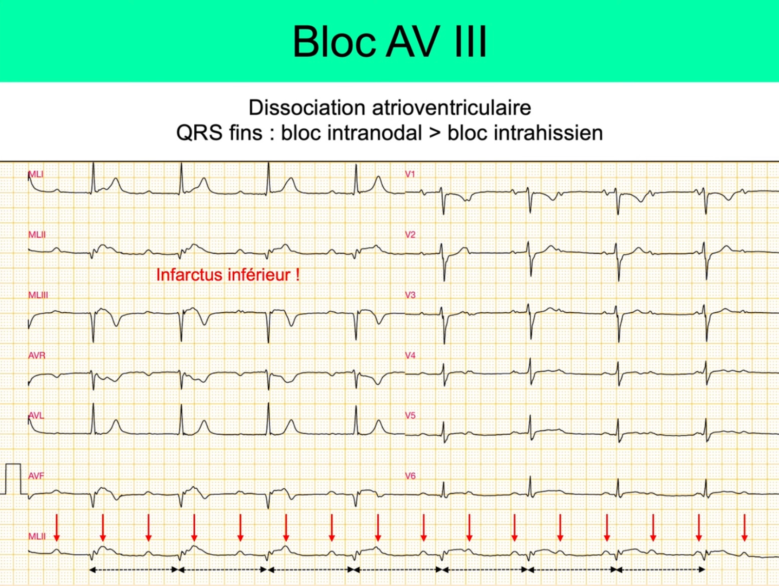 BAV III complet — dissociation AV, P régulières (flèches rouges) et QRS réguliers déconnectés, IDM inférieur