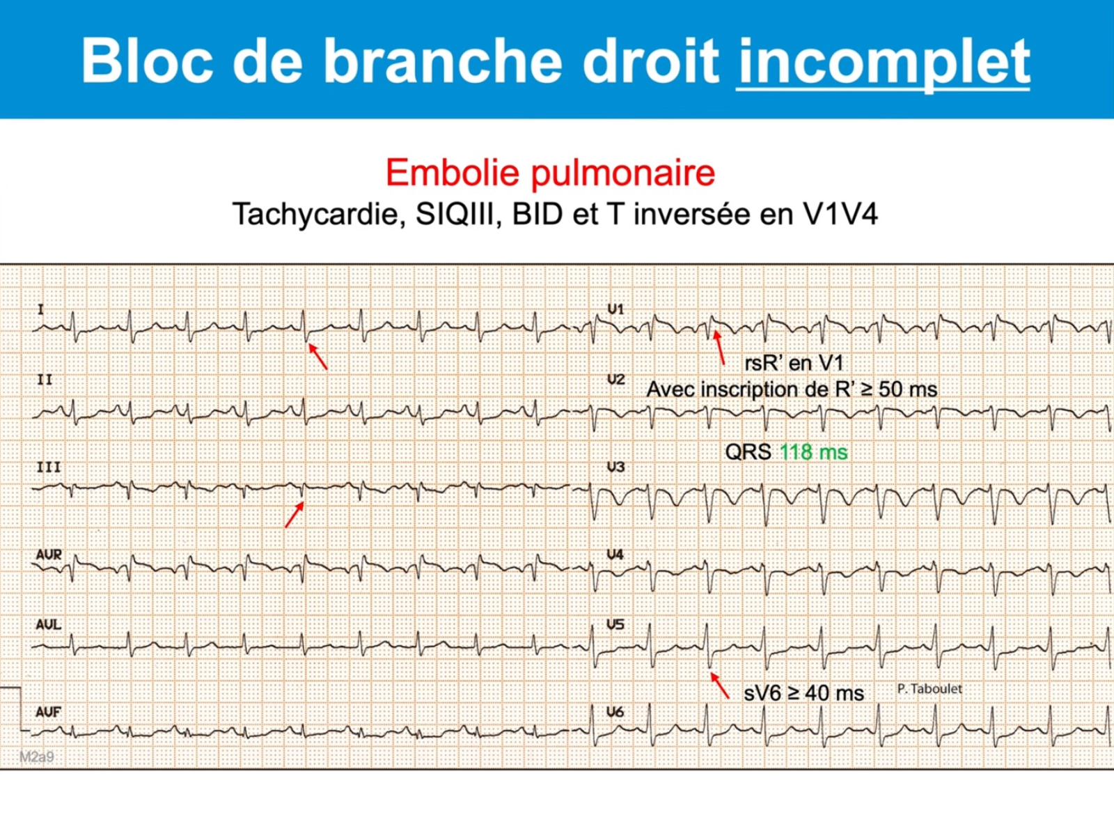 BID dans contexte d'embolie pulmonaire — tachycardie, SIQIII, rsR' V1, QRS 118ms, T négatives V1-V4