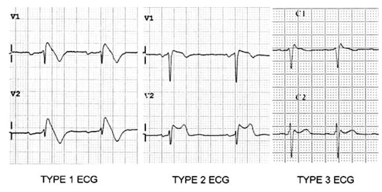 Brugada type 1 (coved), type 2 (saddleback), type 3 — ECG V1-V2