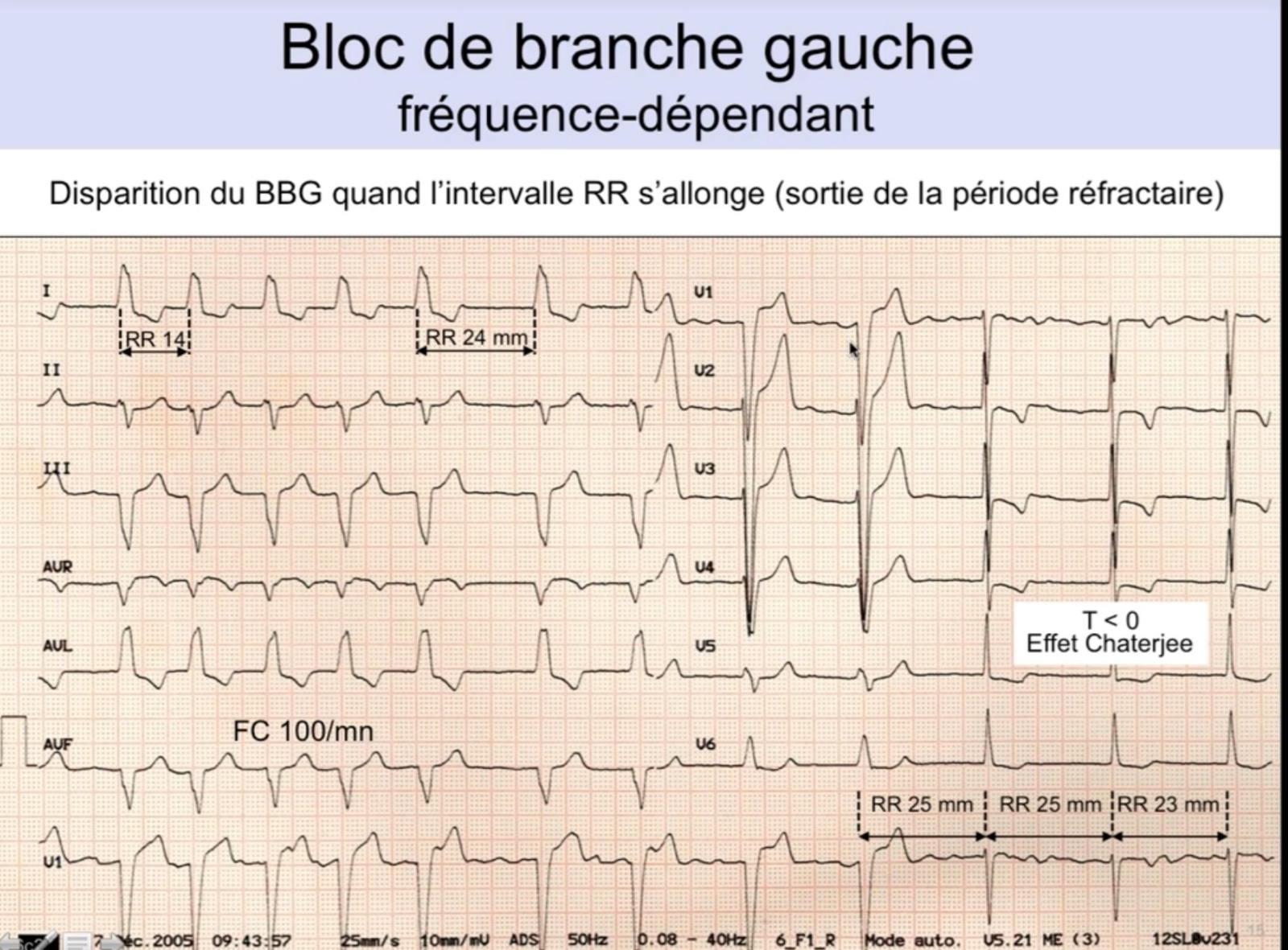 BBG fréquence-dépendant — disparition du BBG quand RR s'allonge, T négative résiduelle effet Chatterjee