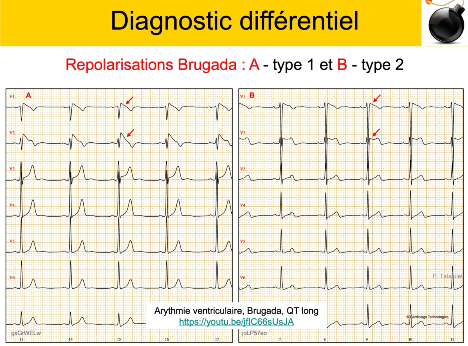 Brugada type 1 vs type 2