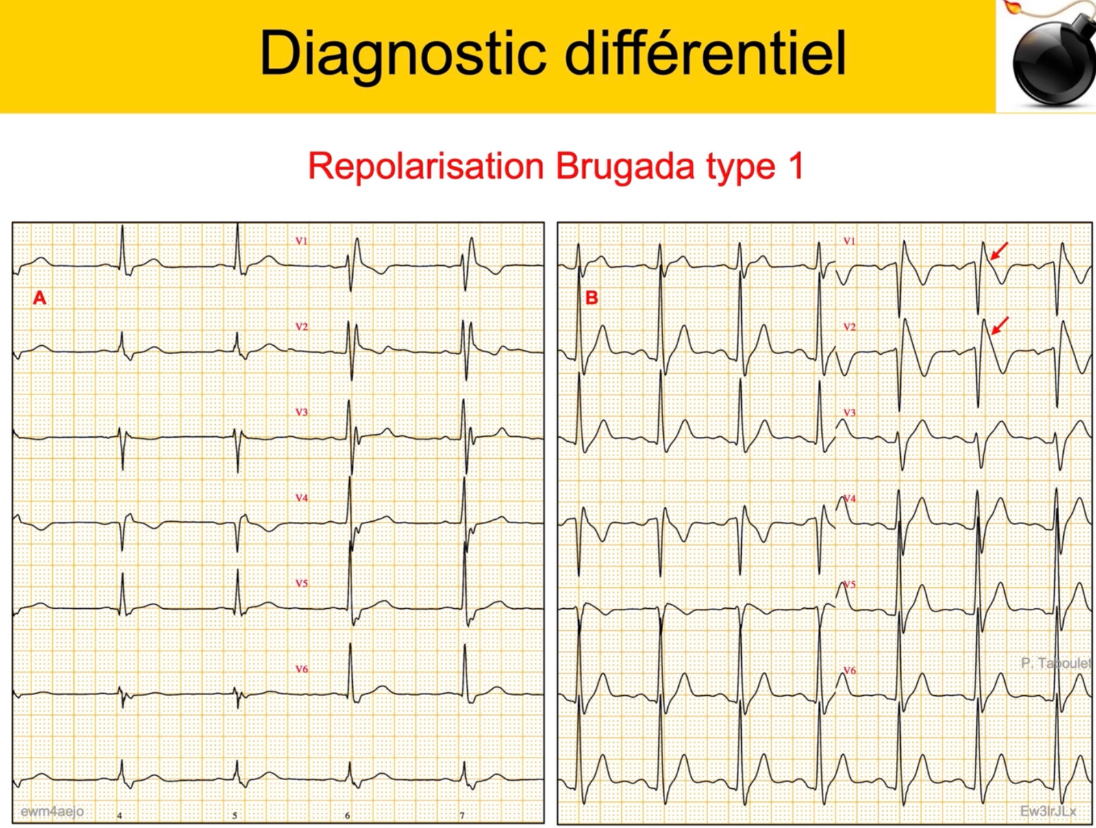 BBD vs Brugada type 1