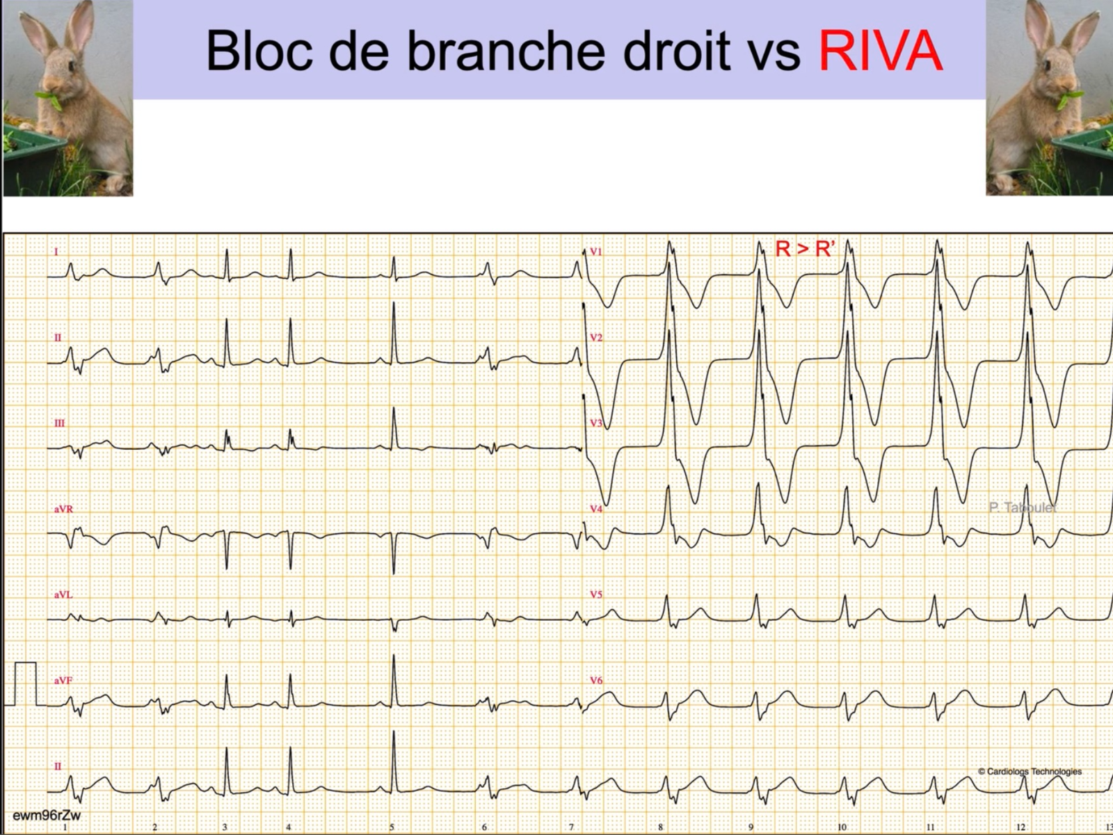 RIVA — transition sinusal vers ventriculaire