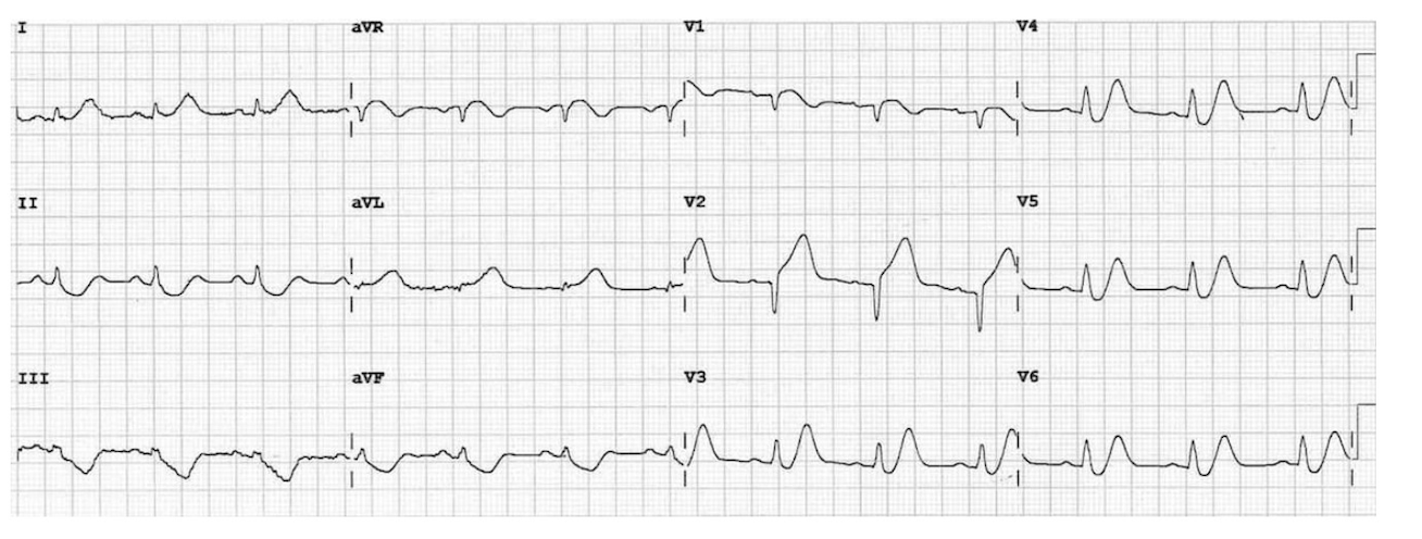 De Winter + STEMI antérieur — occlusion LAD proximale, T pointues V3-V6 + ST↑ V1-V2 et aVL