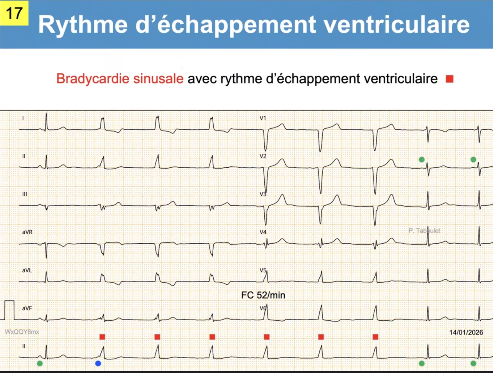 Échappement ventriculaire — QRS larges, dissociation AV