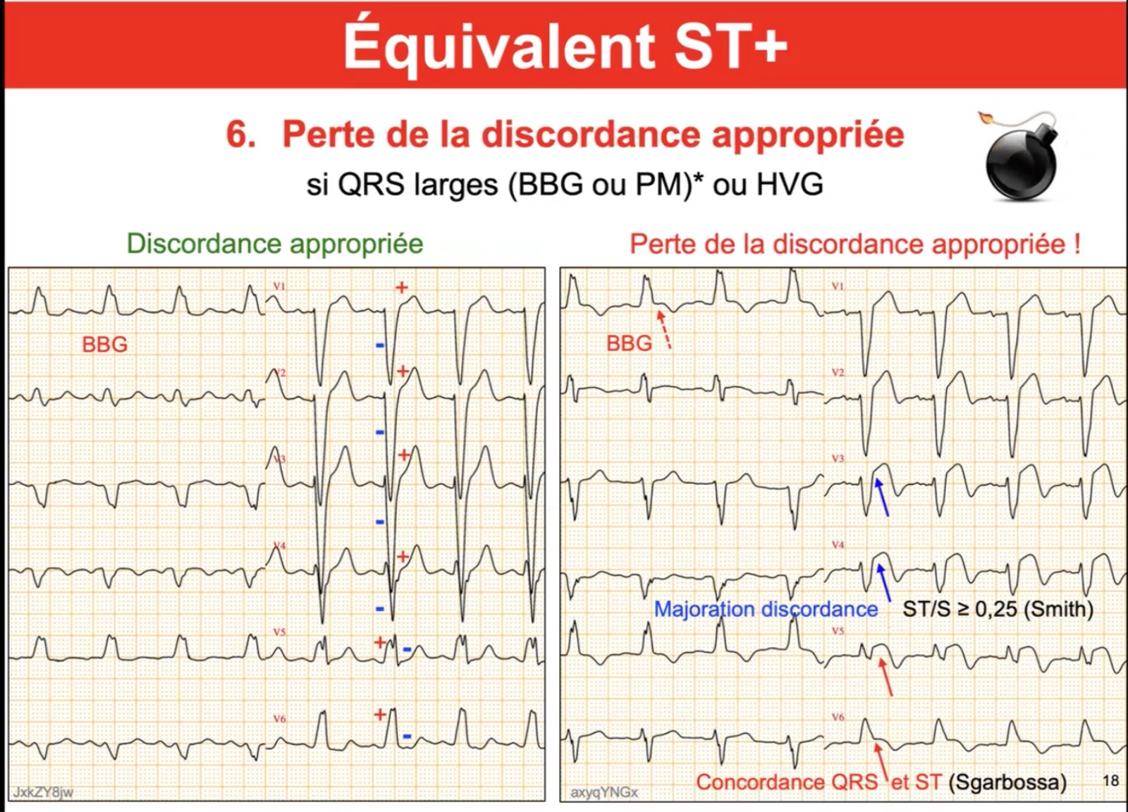 Équivalent ST+ #6 — Perte de la discordance appropriée, comparaison BBG normal vs ischémique