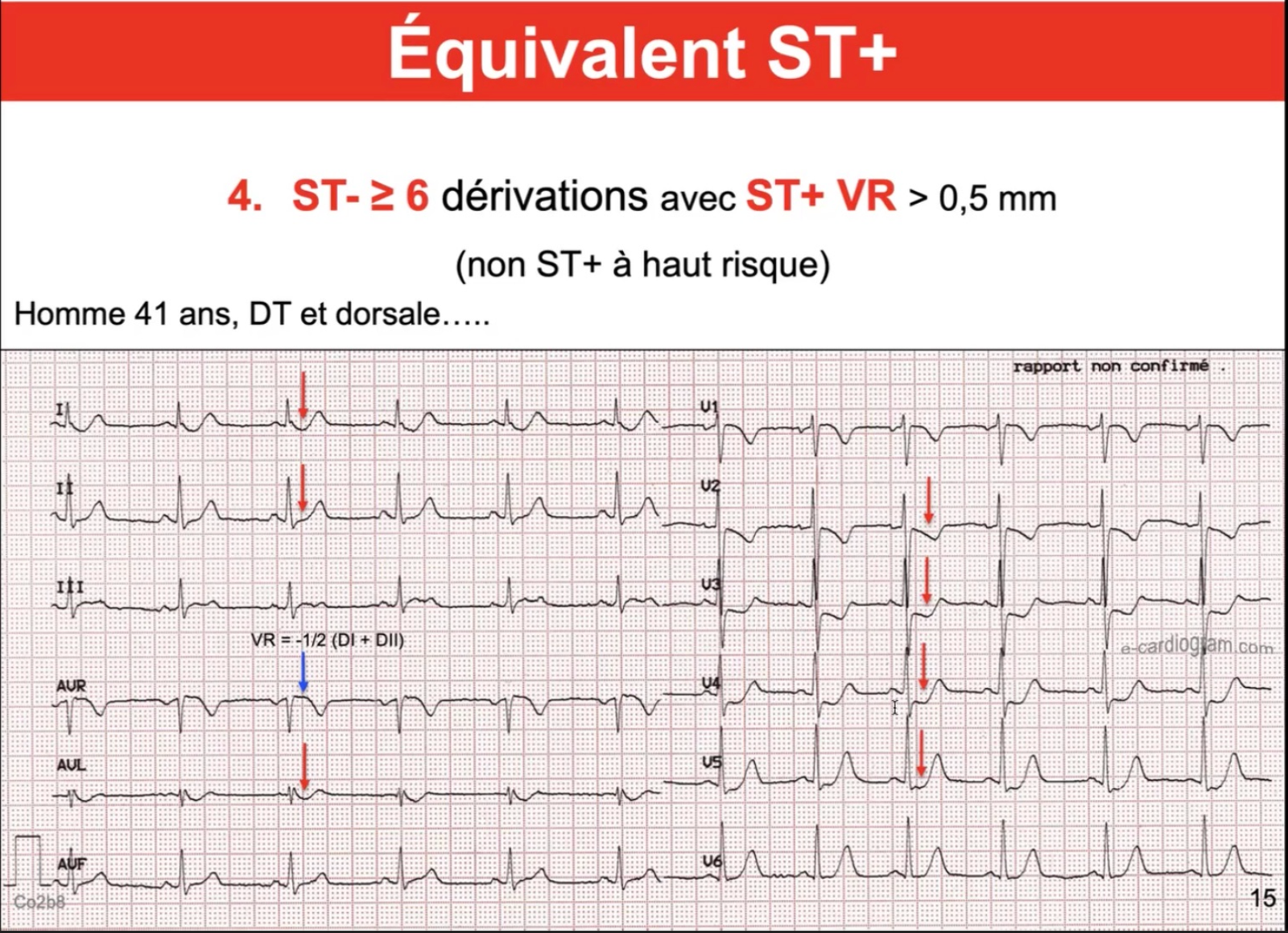 Équivalent ST+ — ST- diffuse 6 dérivations + ST+ aVR, tronc commun