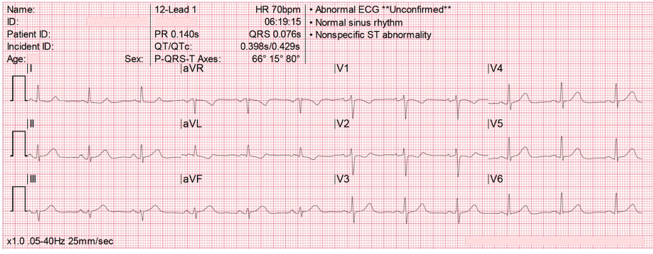 Ondes T hyperaiguës inférieures — T dépasse le QRS en DIII/aVF, ST↓ miroir V1-V3, machine dit nonspecific ST abnormality