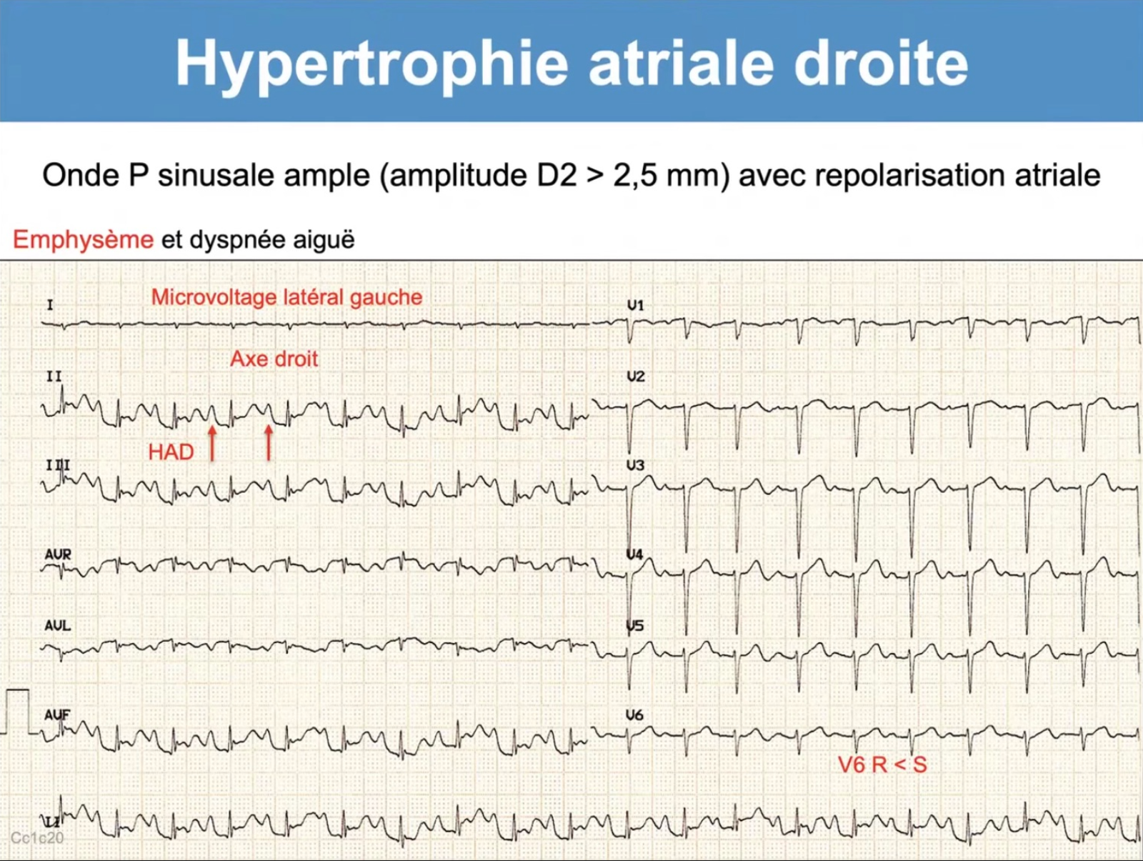 HAD avec repolarisation atriale visible — emphysème, axe droit, microvoltage