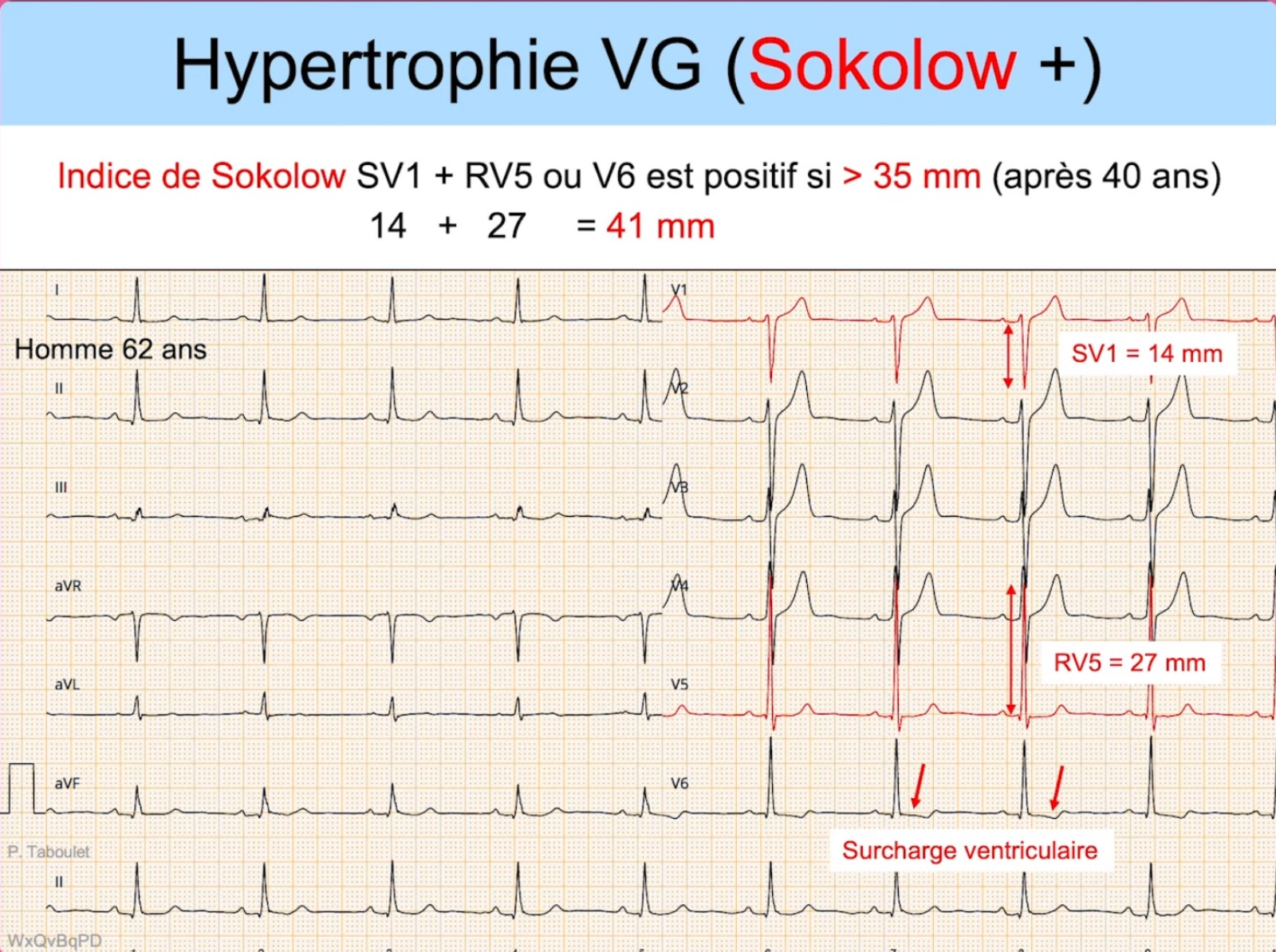 HVG — Sokolow positif SV1+RV5 = 41 mm, surcharge ventriculaire