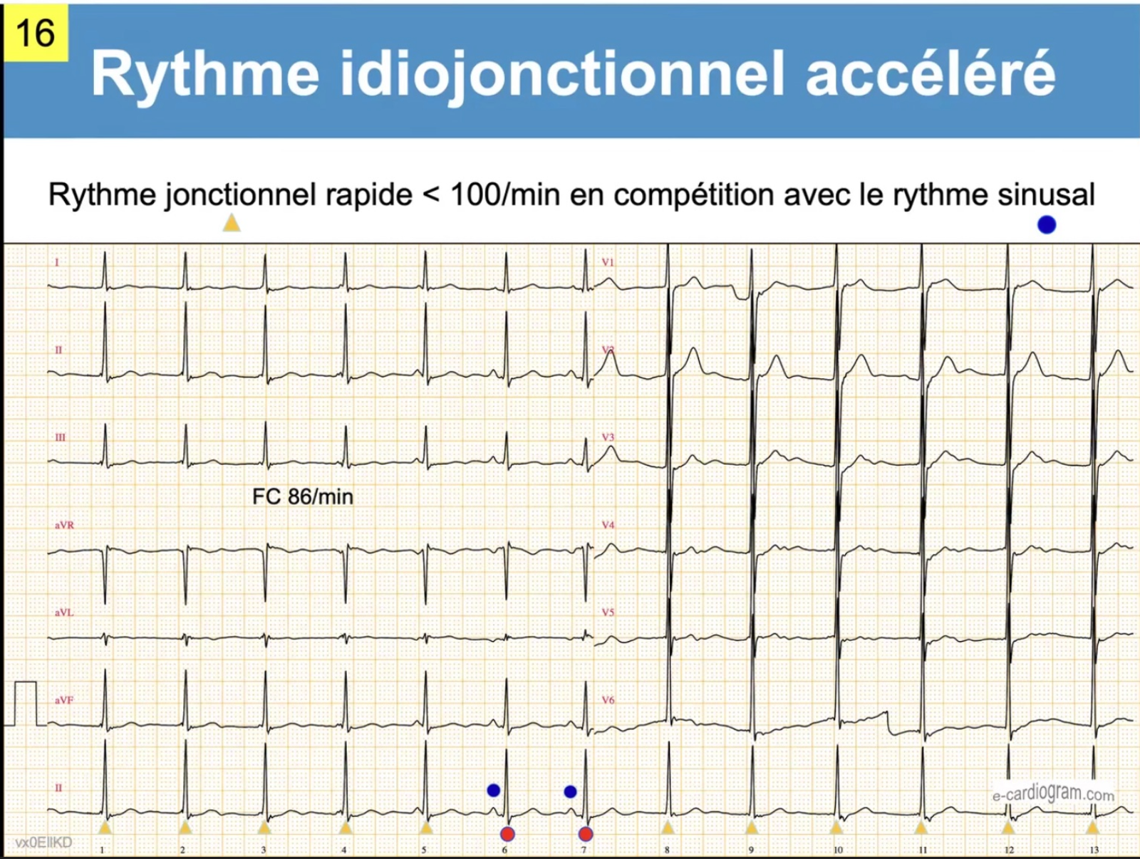 Rythme jonctionnel en compétition avec rythme sinusal