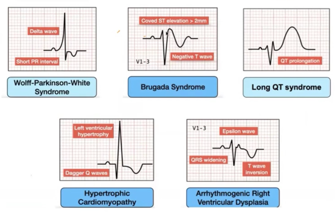 ECG Killers — WPW, Brugada, QT long, CMH, DAVD