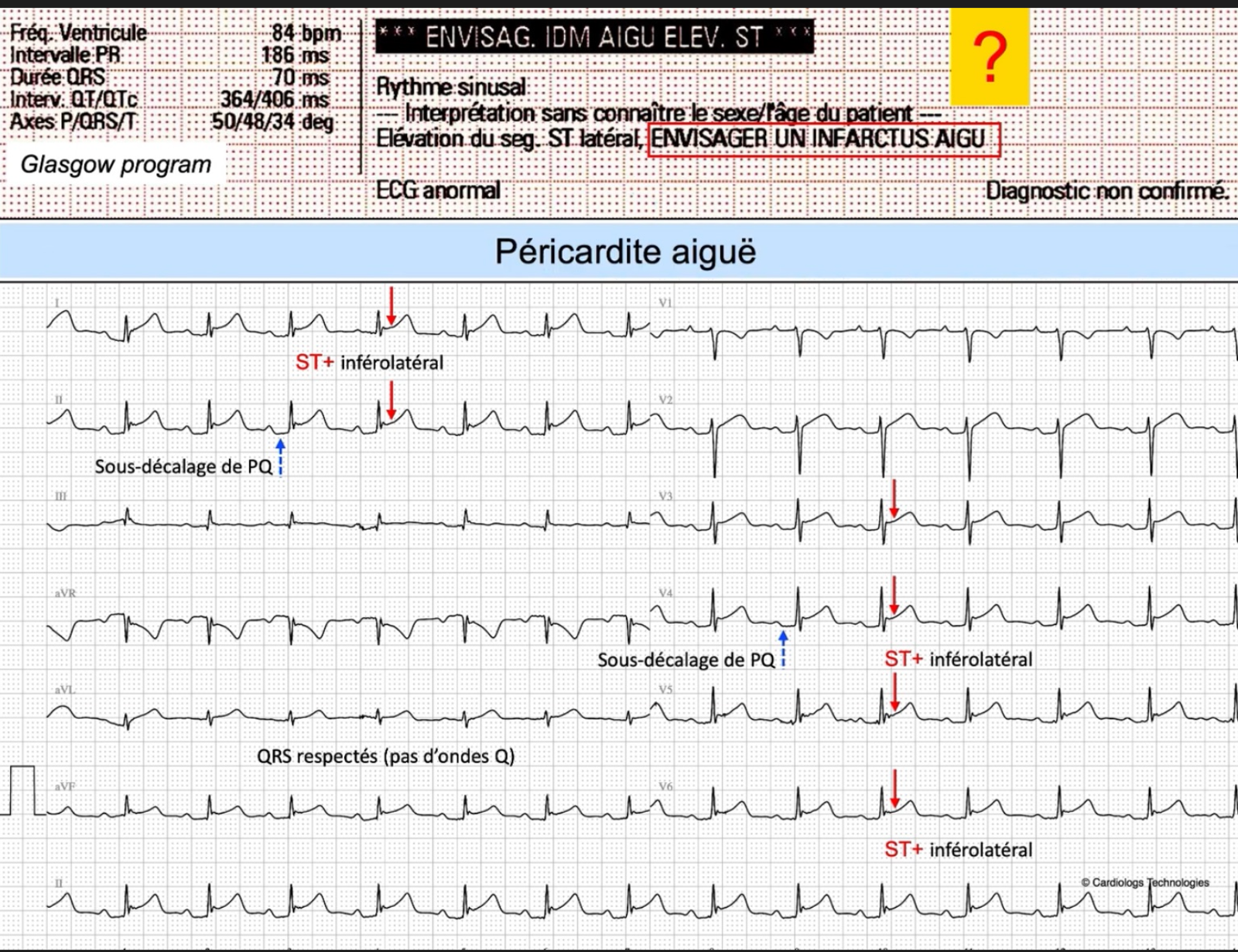 Péricardite aiguë — machine conclut ENVISAGER INFARCTUS AIGU, PQ↓, QRS respectés