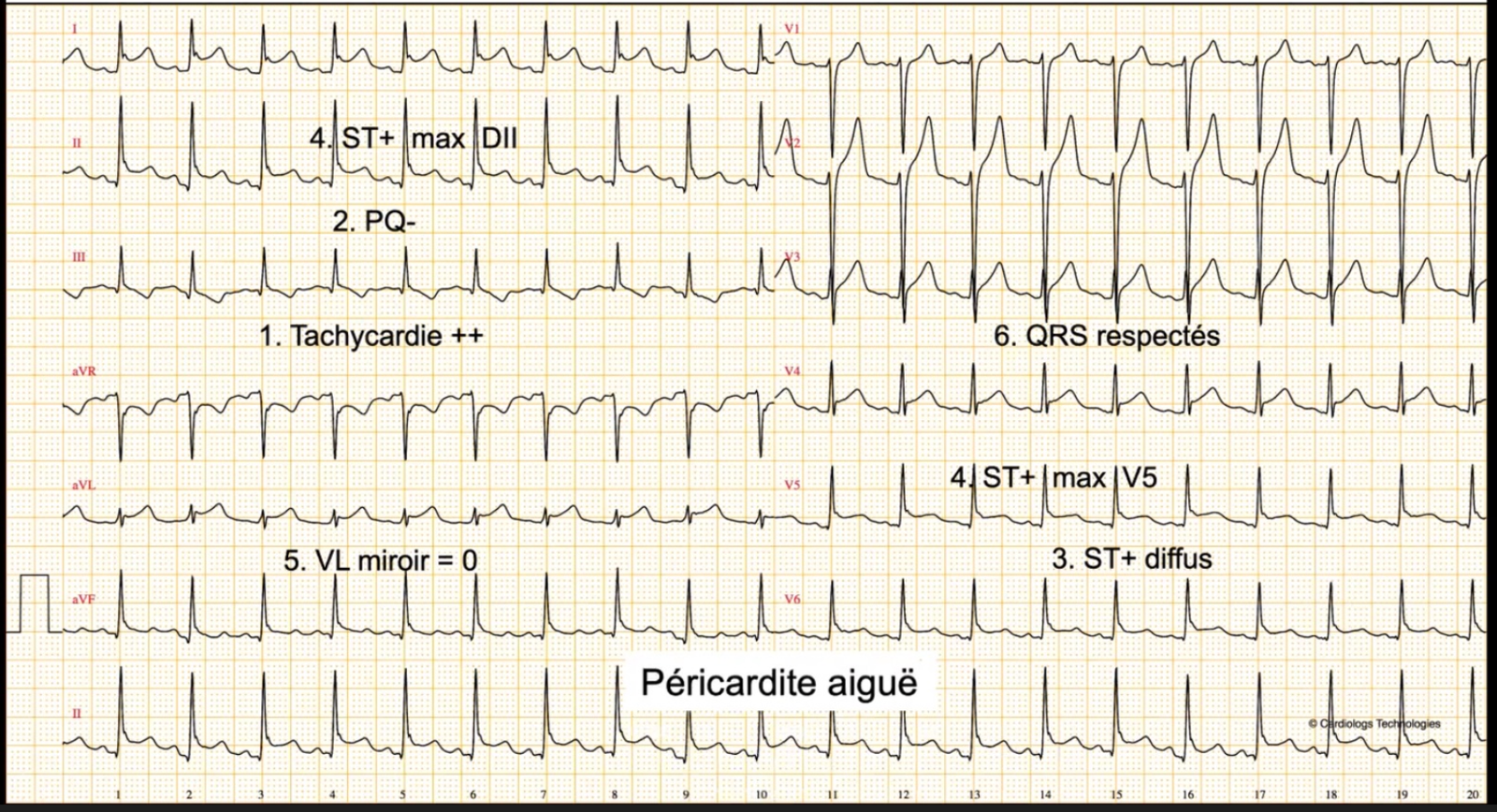 Péricardite aiguë — ST+ diffus, PQ négatif, tachycardie, aVL miroir = 0, QRS respectés
