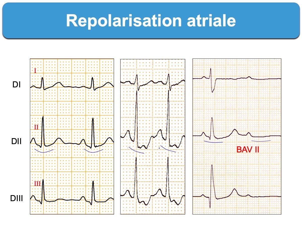 Repolarisation atriale — onde Ta visible sous la ligne de base en DI, DII, DIII