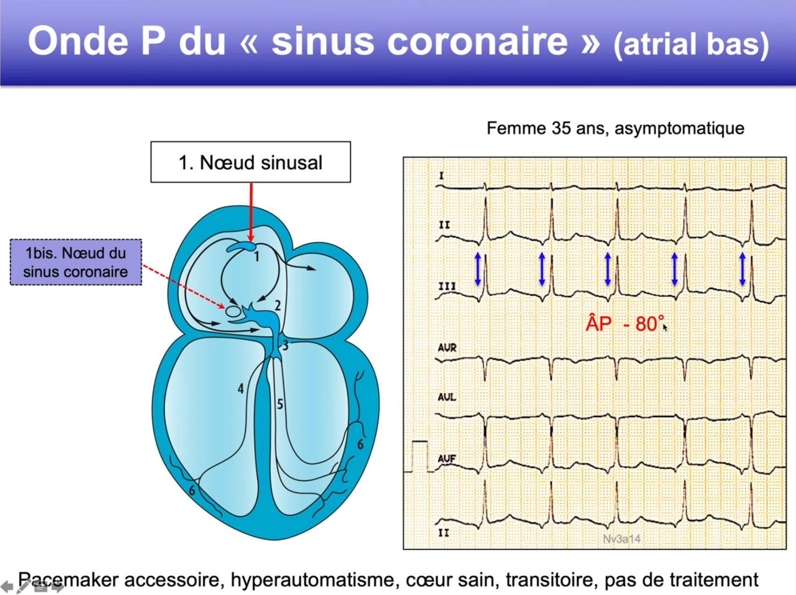 Onde P du sinus coronaire — schéma anatomique nœud 1bis + ECG P négative DII/DIII, axe P −80°