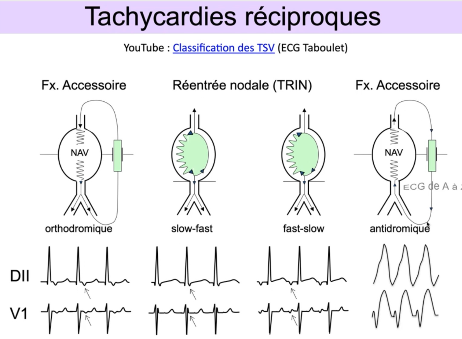 Tachycardies réciproques — orthodromique, TRIN slow-fast, TRIN fast-slow, antidromique