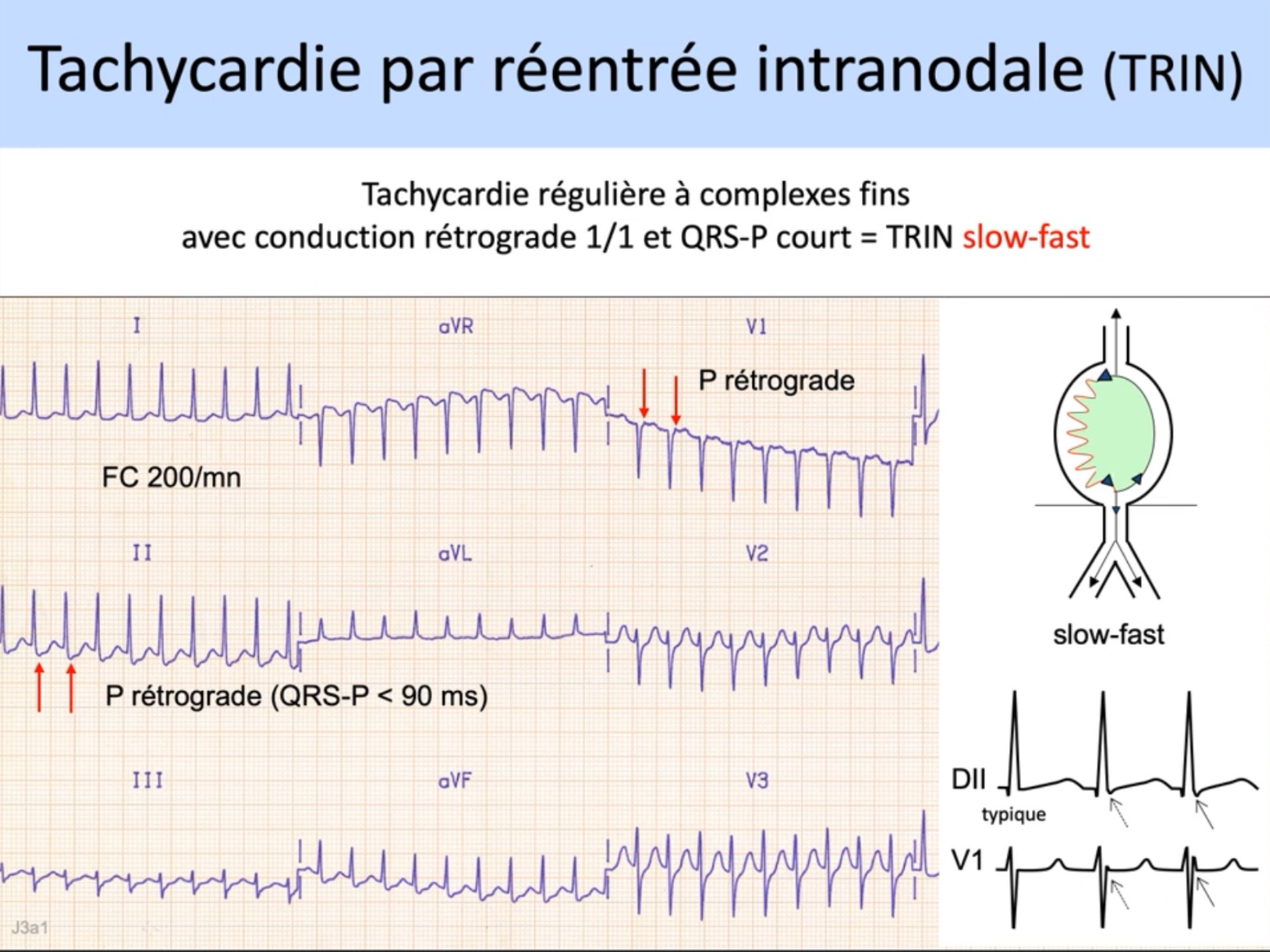 TRIN — tachycardie régulière QRS fins FC 200/min, P rétrograde QRS-P < 90ms, forme slow-fast