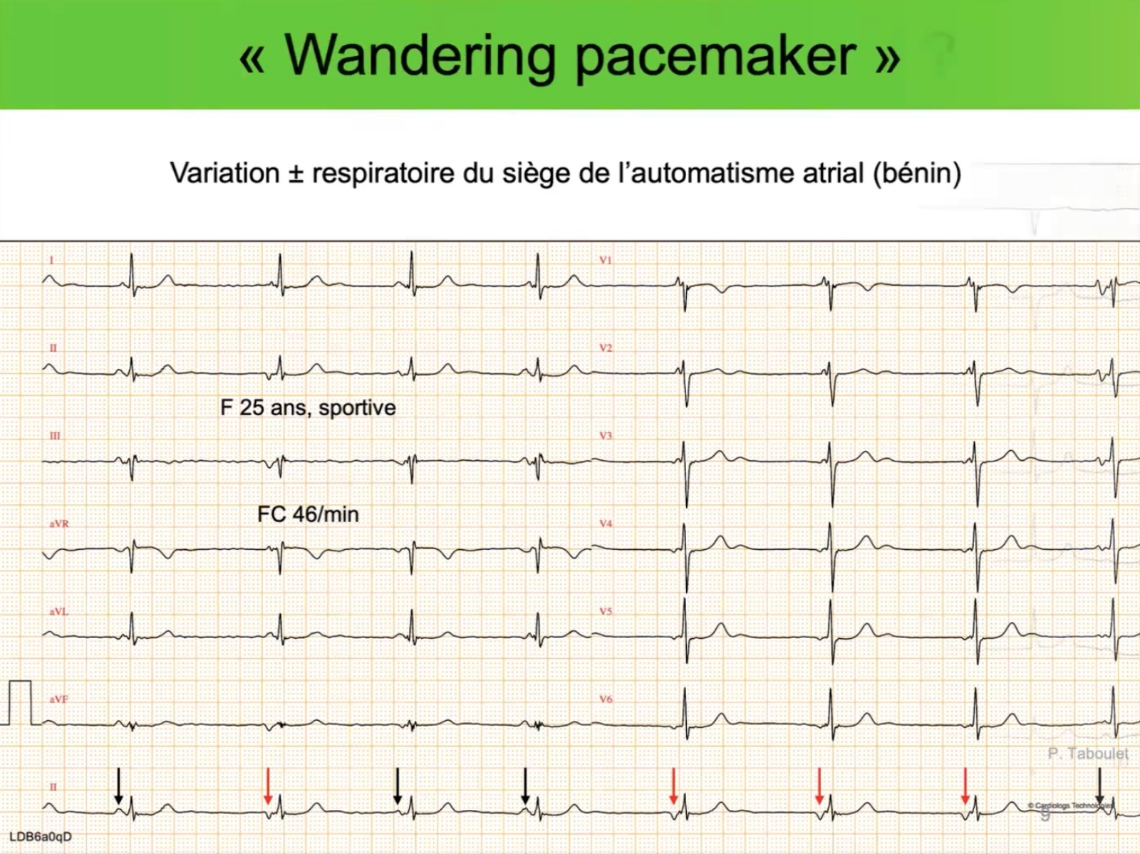 Wandering pacemaker — variation morphologie onde P, sportive 25 ans, FC 46/min
