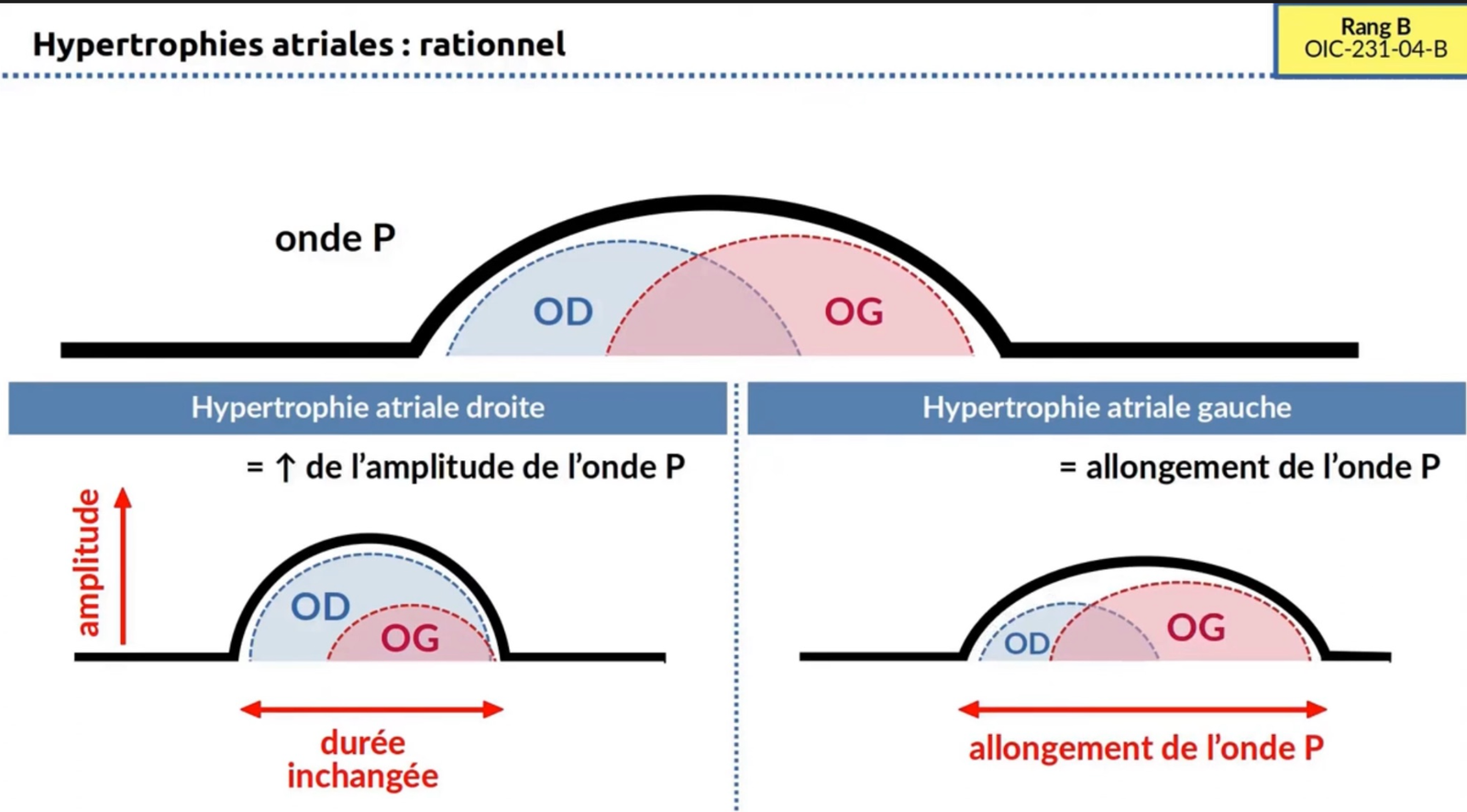 Rationnel hypertrophies atriales — HAD amplitude, HAG durée