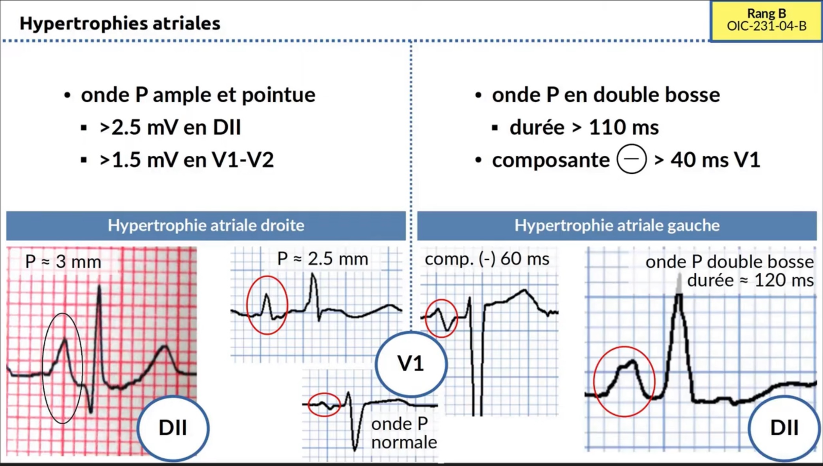 Hypertrophies atriales — tracés ECG HAD et HAG comparatifs