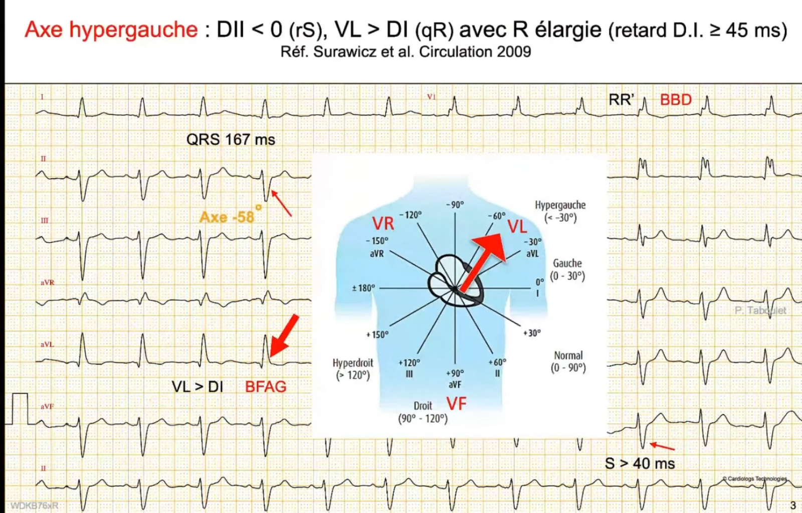 HBAG — tracé 12 dérivations, aVL > DI