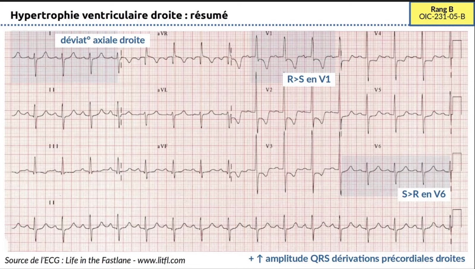 HVD résumé ECG 12 dérivations