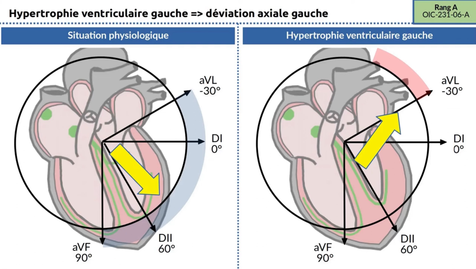 HVG — déviation axiale gauche