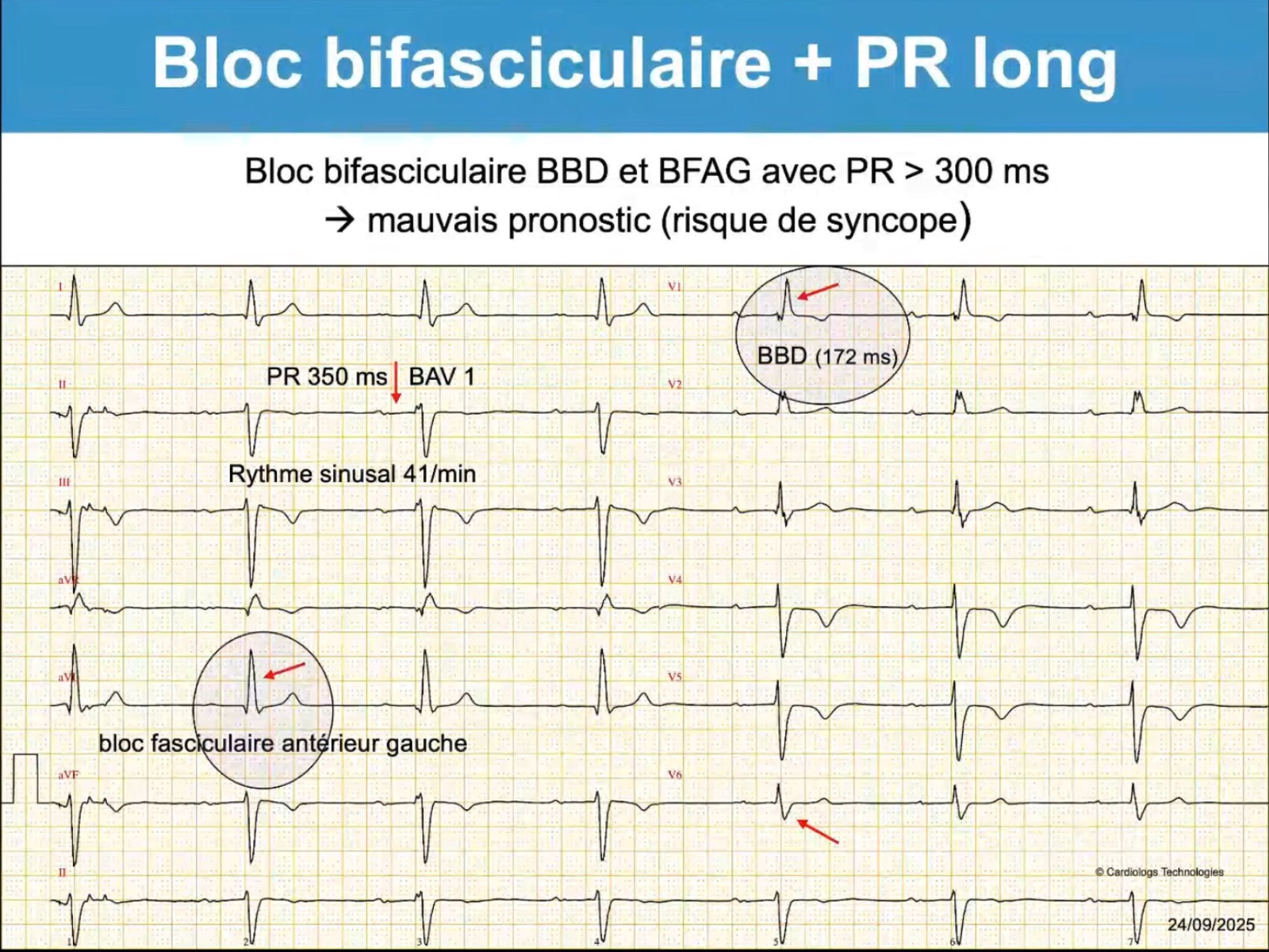 Bloc trifasciculaire — BBD + HBAG + PR 350ms