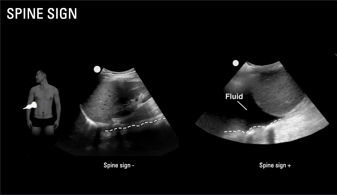 Pelvis eFAST