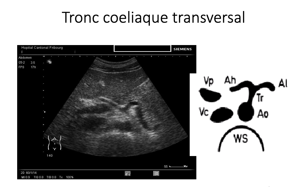 Tronc coeliaque