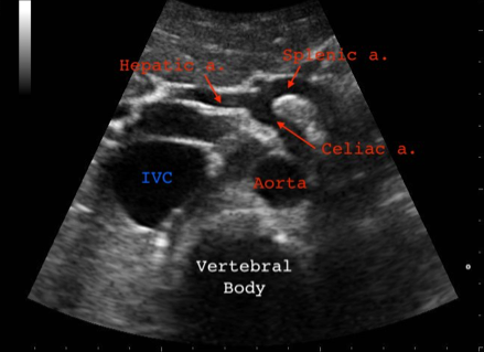 Corps vertébral sous aorte
