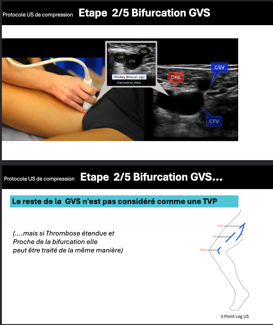 TVP trifurcation détail
